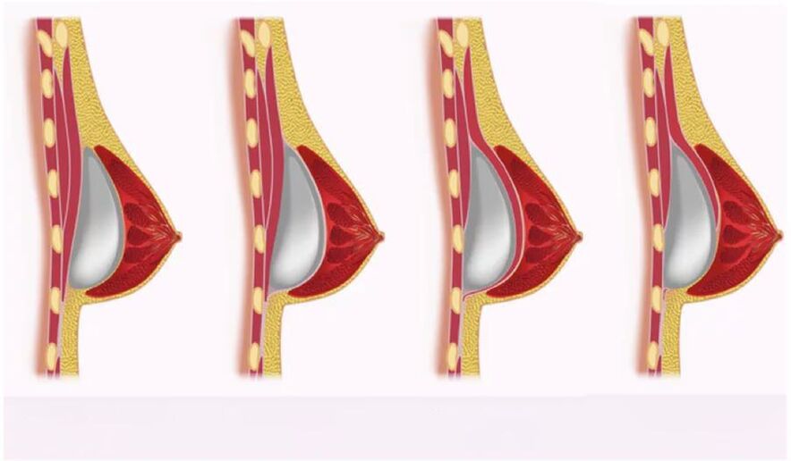 Access for implant installation