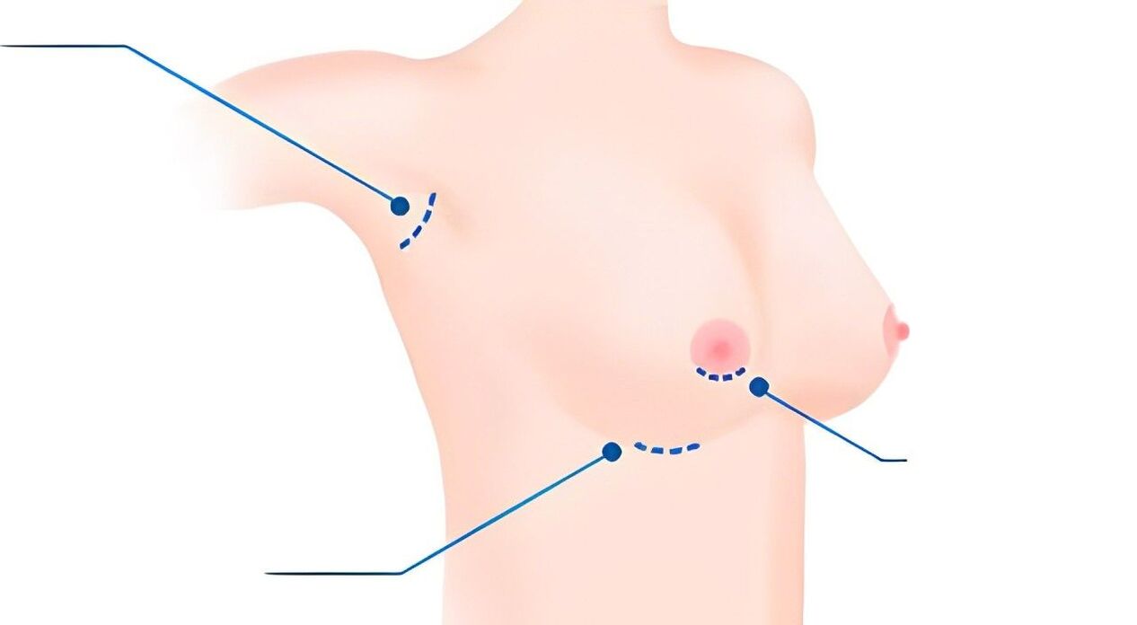 Types of sizes for breast enlargement