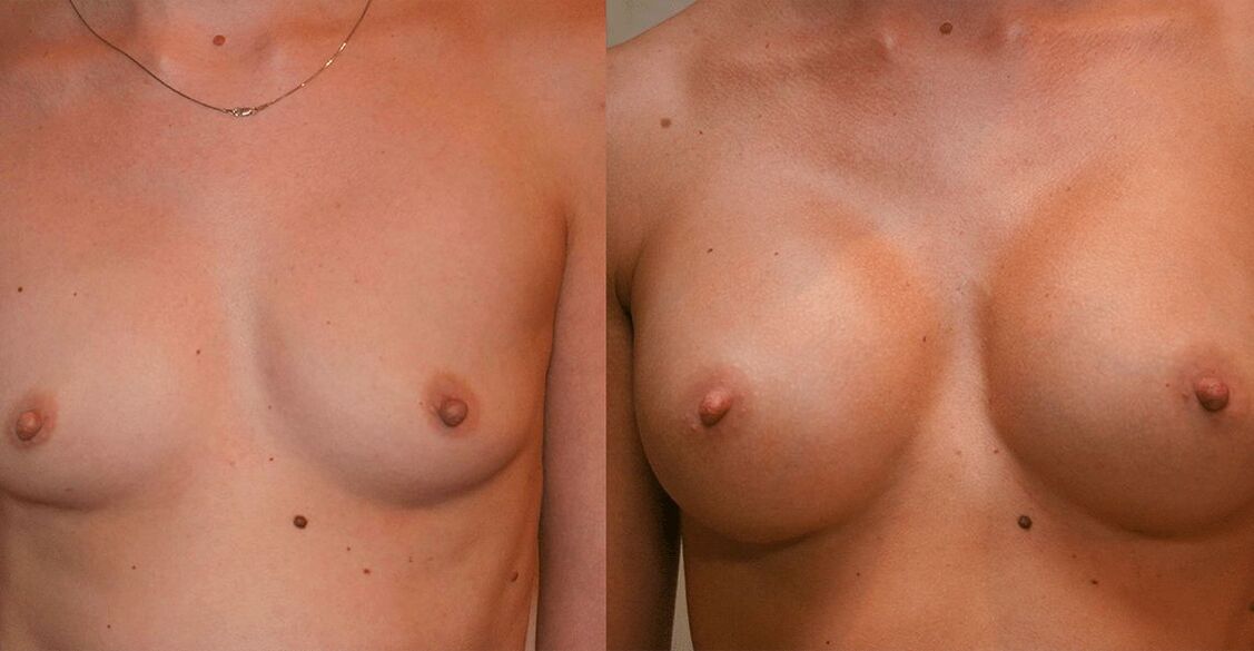 before and after breast enlargement